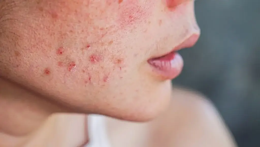 Close-up of a cheek with inflamed, blemish-prone skin