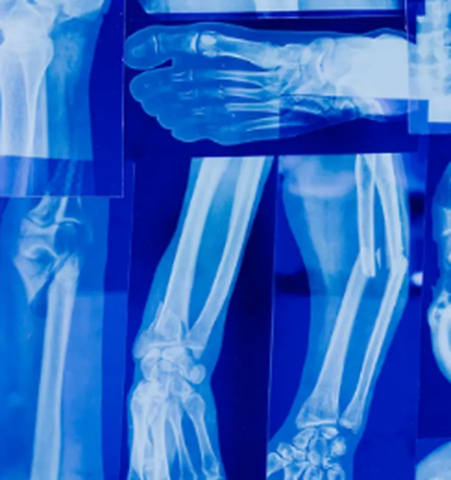 X-ray images of human bones